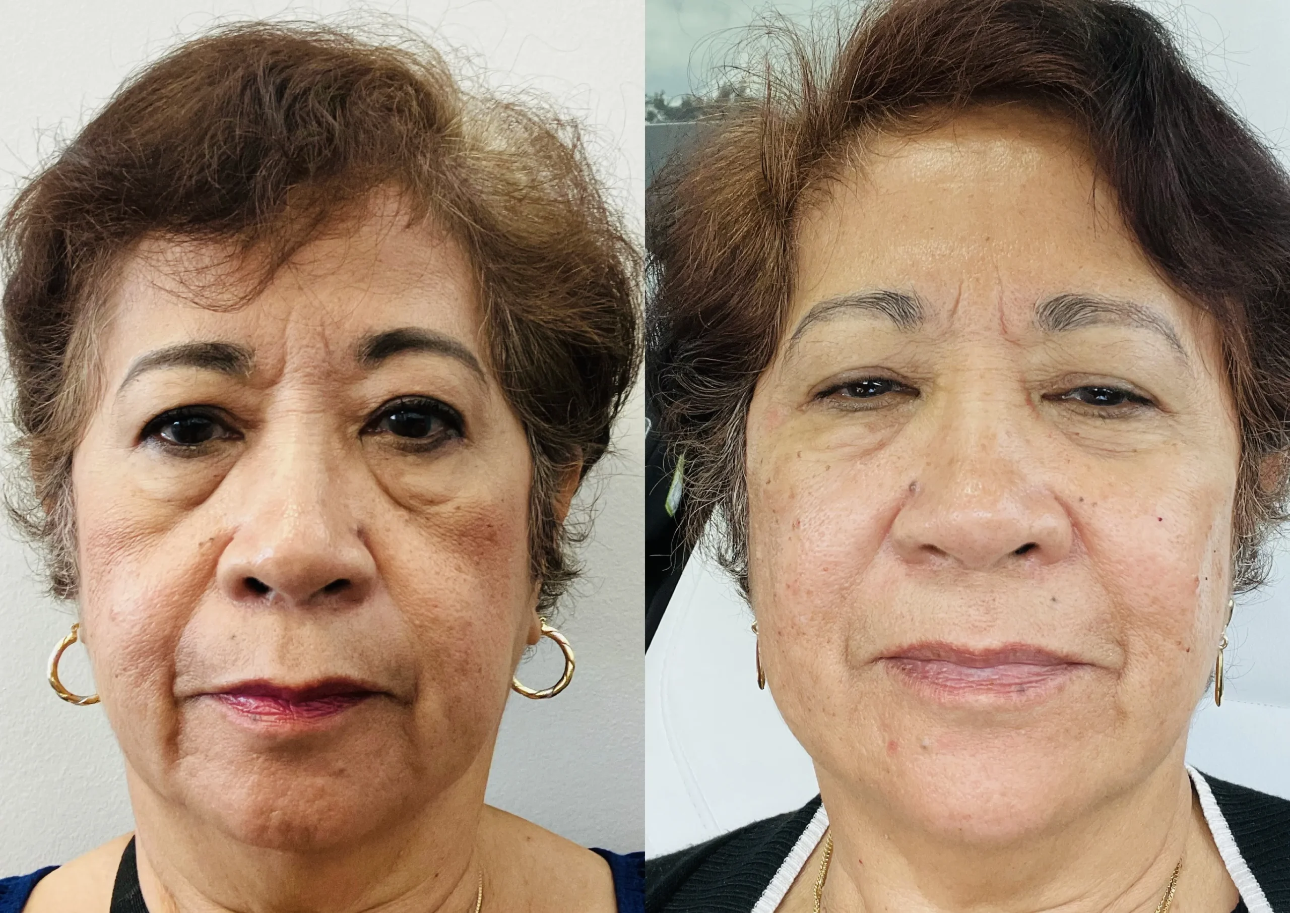 Dermal filler liquid facelift before and after (stacked image)