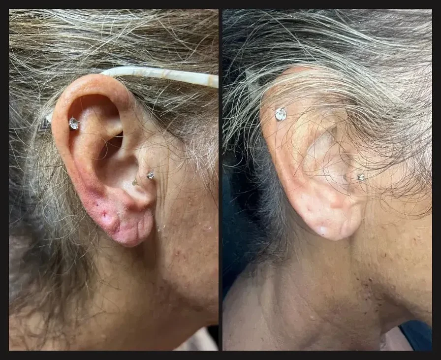 Earlobe dermal filler before and after (stacked image)
