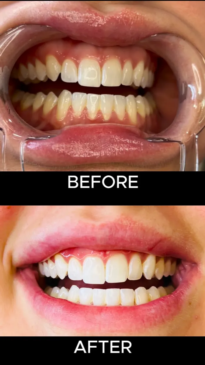 After teeth whitening (smile)