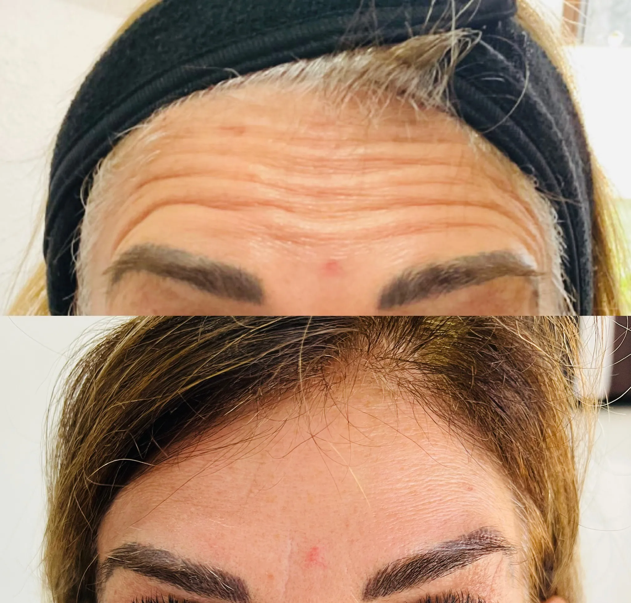 Forehead neuromodulator before and after (stacked image)