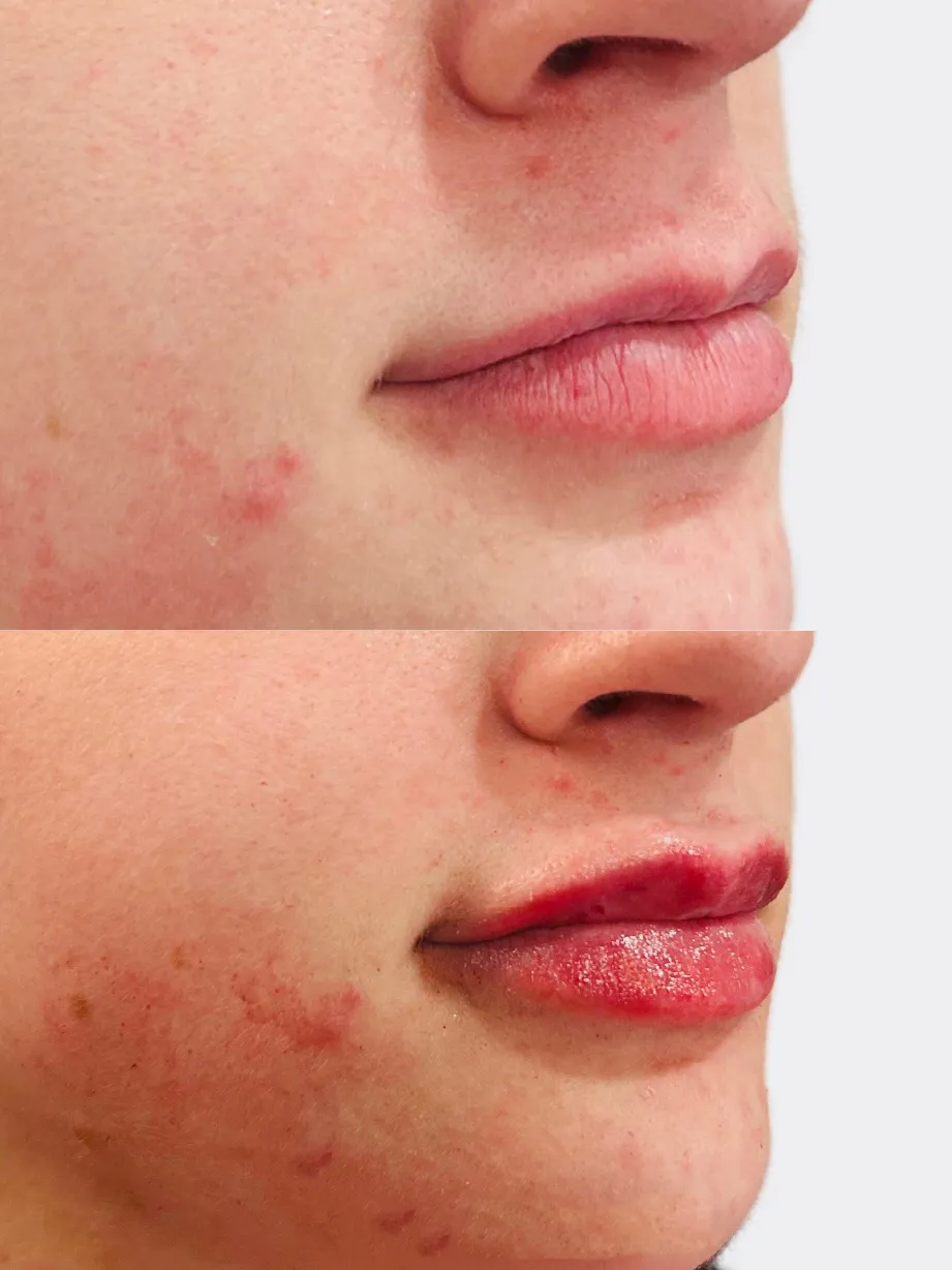 Combo lip enhancement (lip flip plus dermal filler), before and after, view 2 (stacked image)