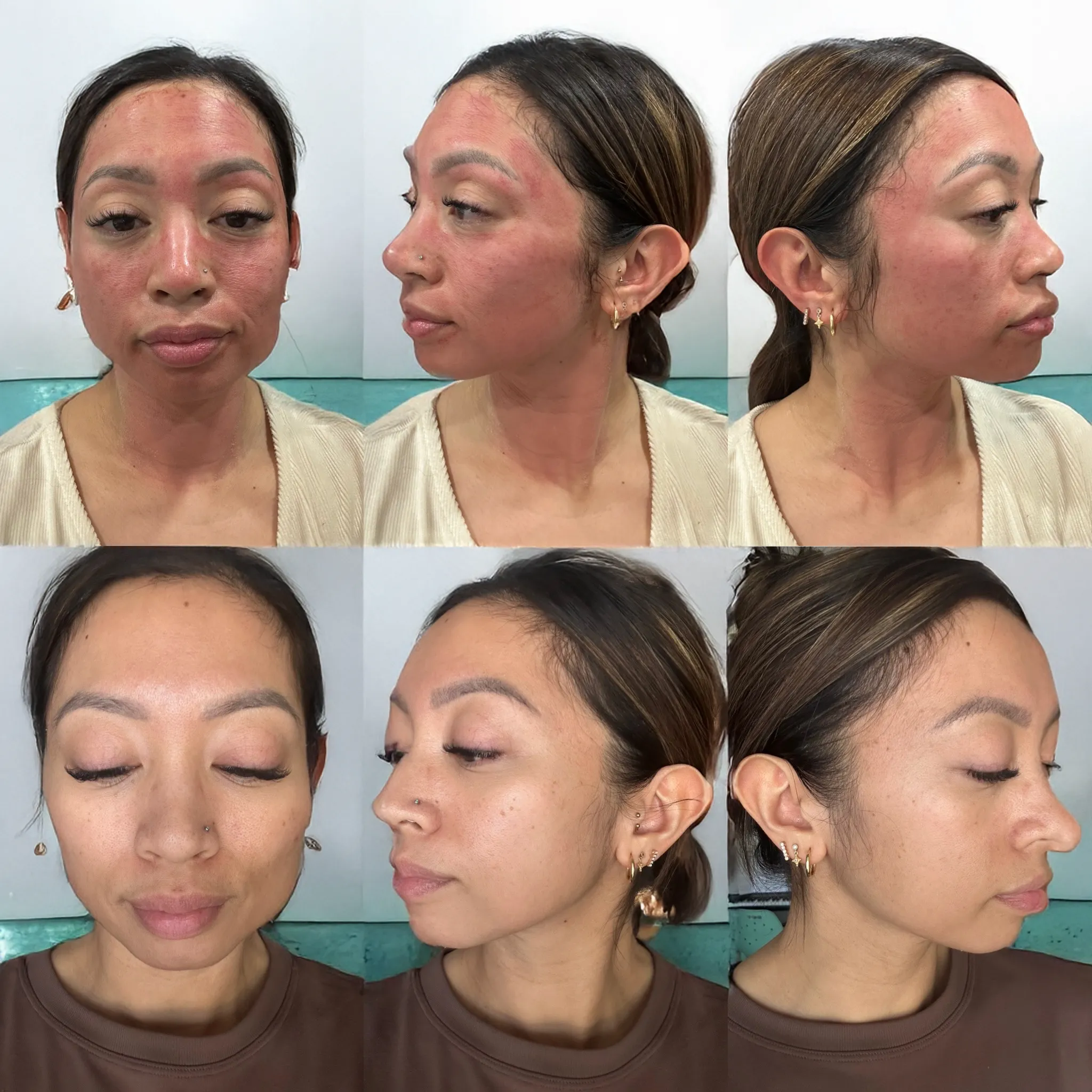 Microneedling with PRP before and after facial treatment (stacked image)