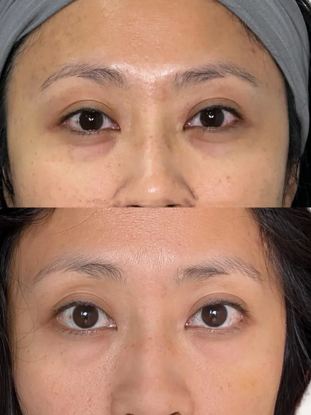 PRF under-eye regenerative treatment before and after (stacked image)