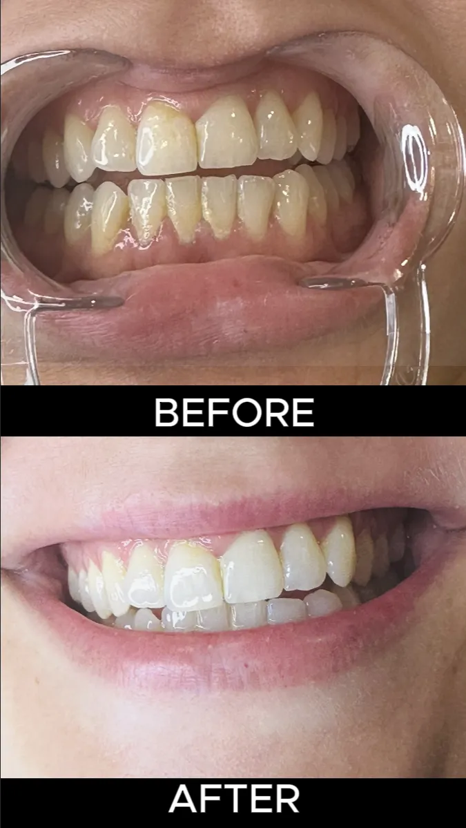 Before teeth whitening (smile)