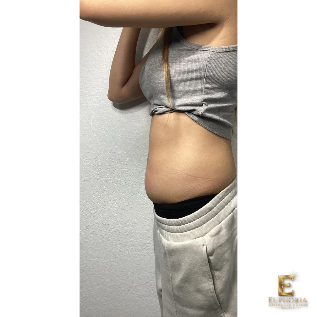 EMS + RF Body Sculpting — Abdomen — After 4 treatments | Euphoria Side view of an Euphoria client’s abdomen after 4 EMS + RF body sculpting treatments.