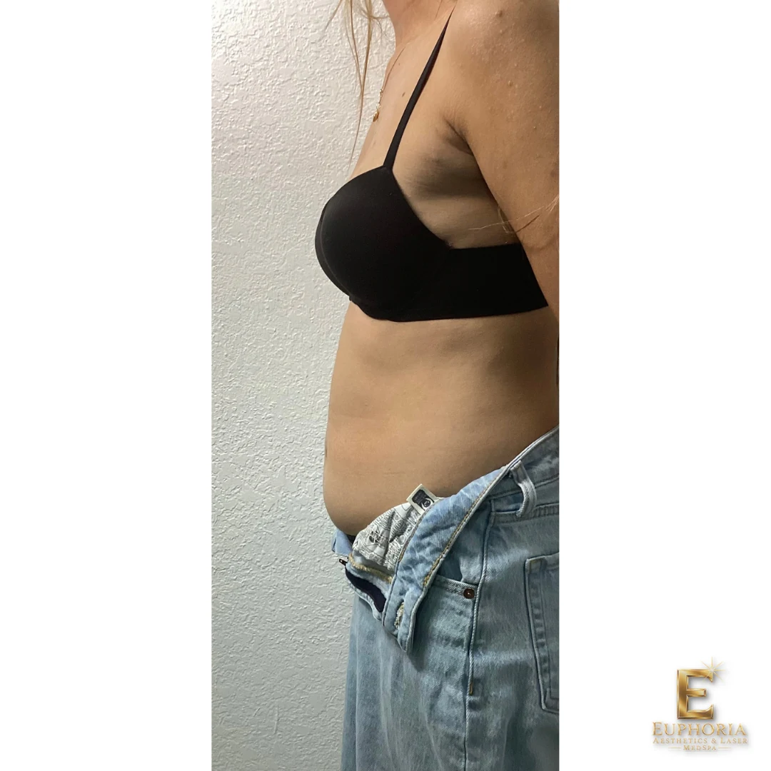EMS + RF Body Sculpting — Abdomen — Before treatment | Euphoria Side view of an Euphoria client’s abdomen before EMS + RF body sculpting treatment.